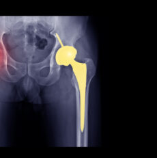 Things you should know about Hip replacement Surgery
