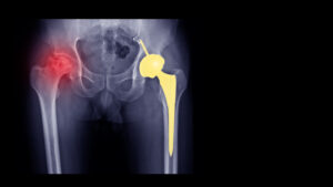 hip replacement pune