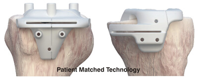 Systems used during TKR surgery