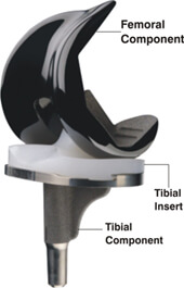 PROSTHESIS OF KNEE JOINT